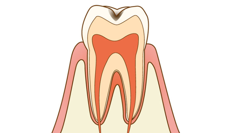 About Cavity Treatment