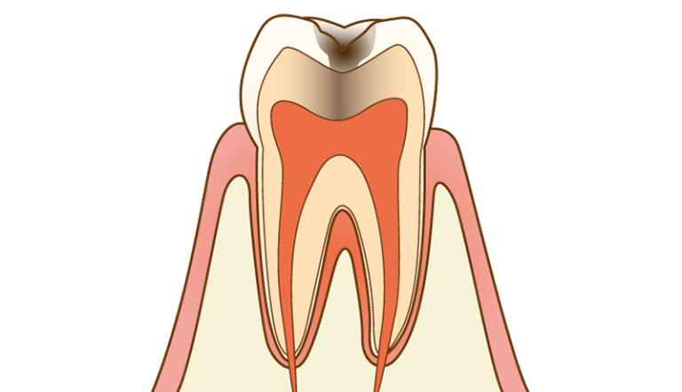 About Cavity Treatment