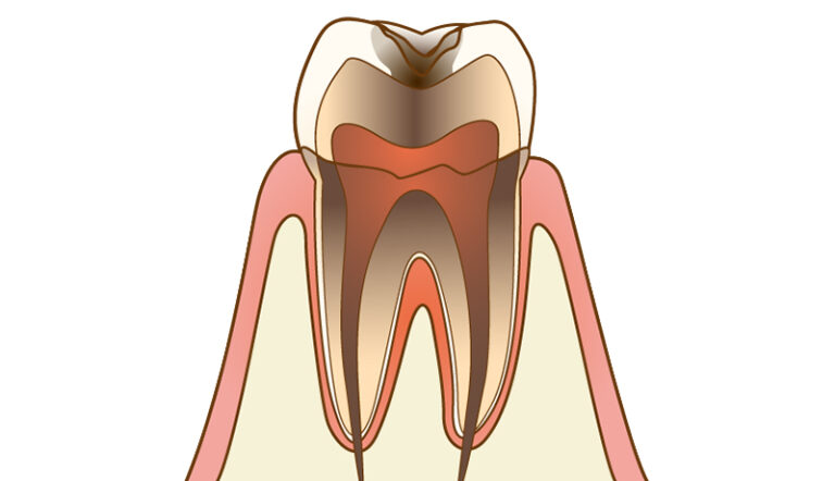 About Cavity Treatment