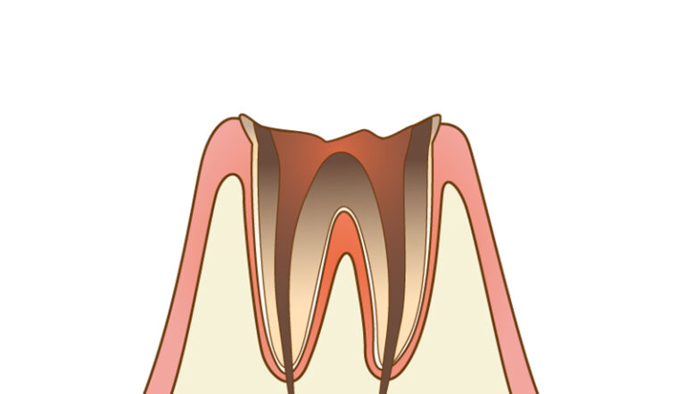 About Cavity Treatment