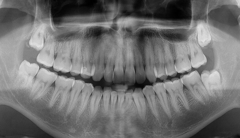 Explanation of wisdom teeth condition