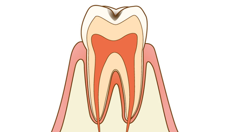 虫歯治療について
