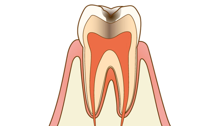 虫歯治療について