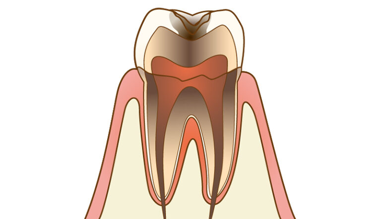 虫歯治療について