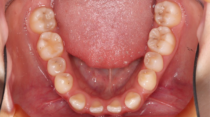 ガミースマイルを矯正治療で改善した症例