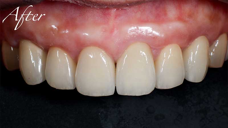 臨床的歯冠長延長術