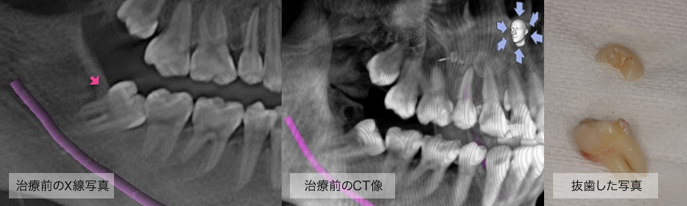 右下の親知らず抜歯レントゲン画像